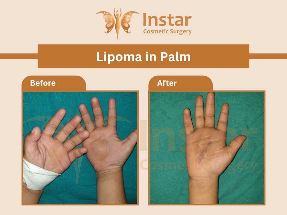 Lipoma-In-Palm