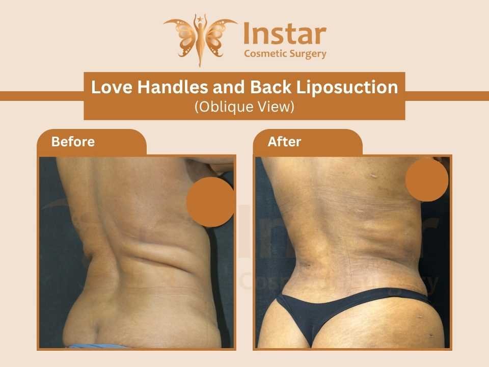 Love-Handles-and-Back-Liposuction-Oblique-View