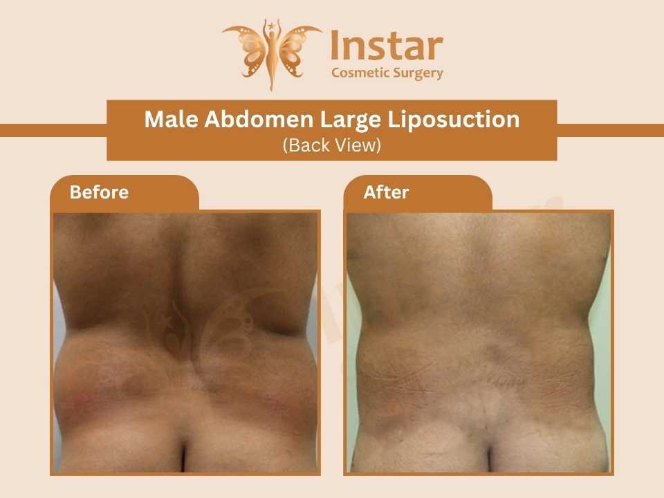 Male-Abdomen-Large-Liposuction-Back-View-1