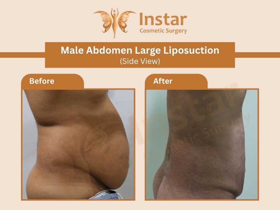 Male-Abdomen-Large-Liposuction-Side-View-1