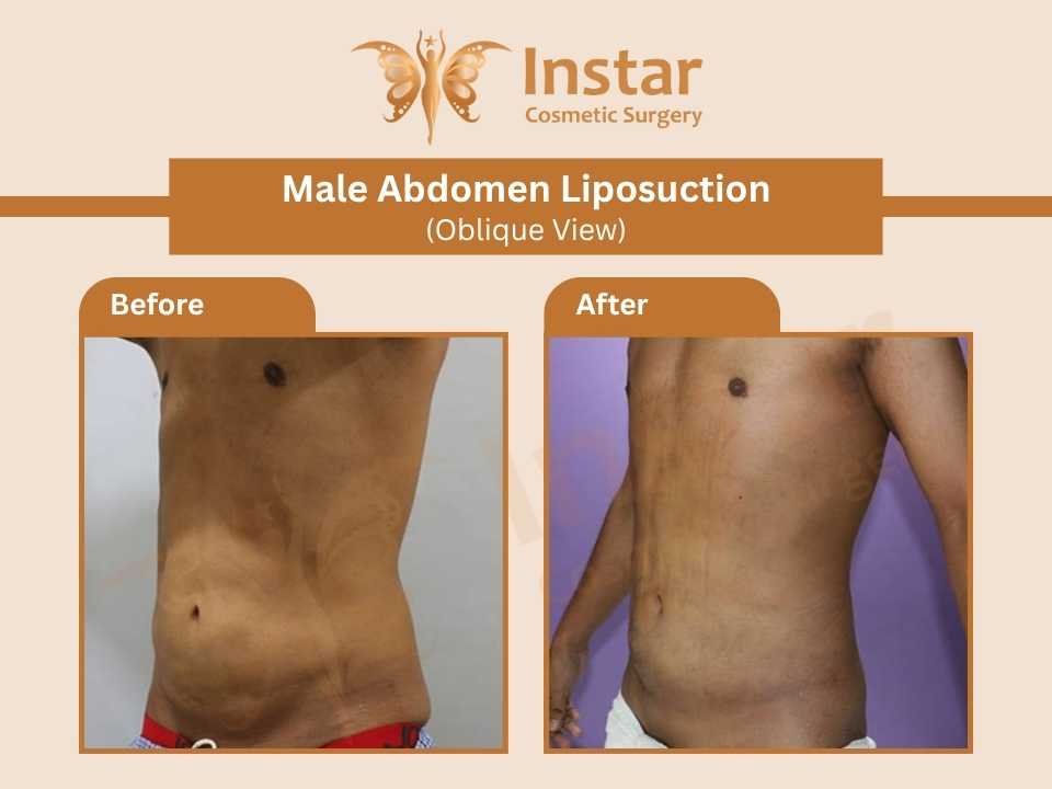 Male-Abdomen-Liposuction-Oblique-View-2