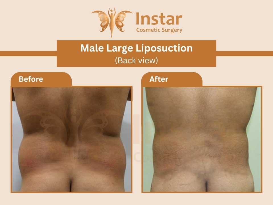 Male-Large-Liposuction-Back-view-1