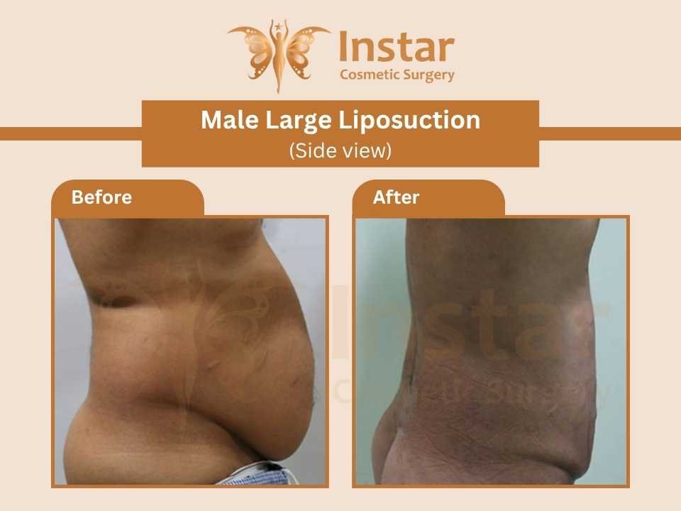 Male-Large-Liposuction-Side-view-1