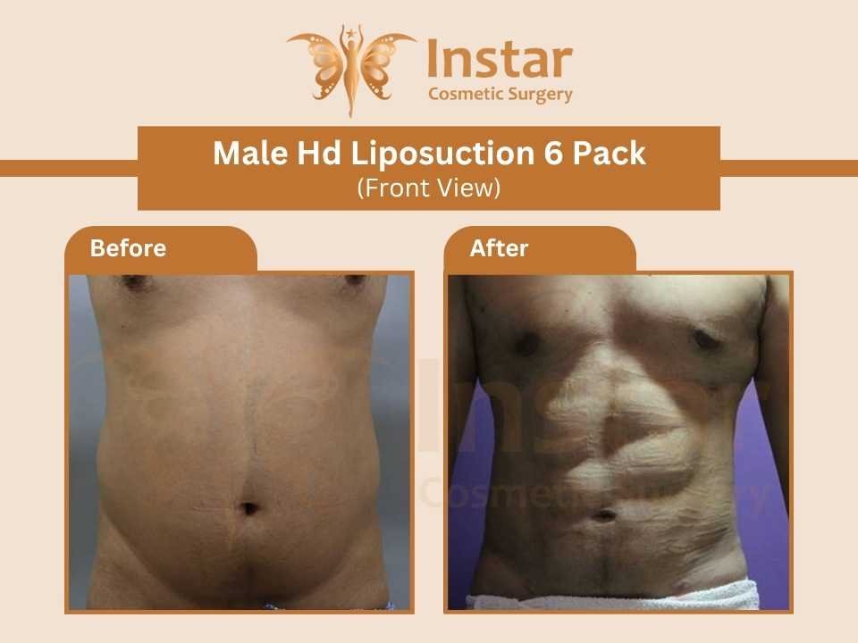 Male-hd-liposuction-6-pack-front-view-2