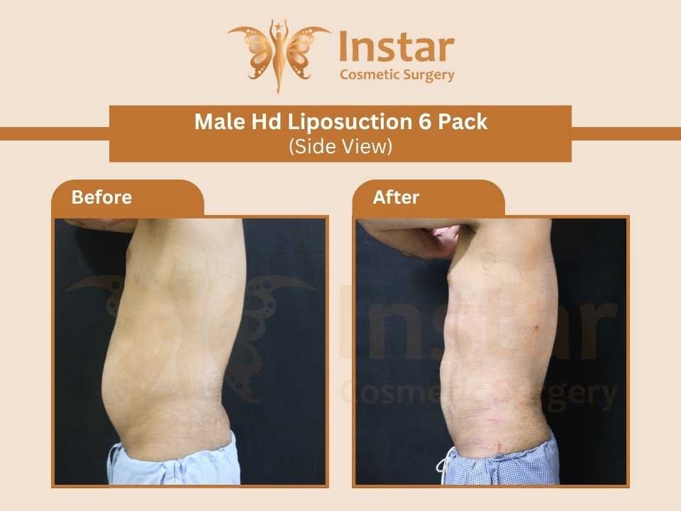 Male-hd-liposuction-6-pack-side-view