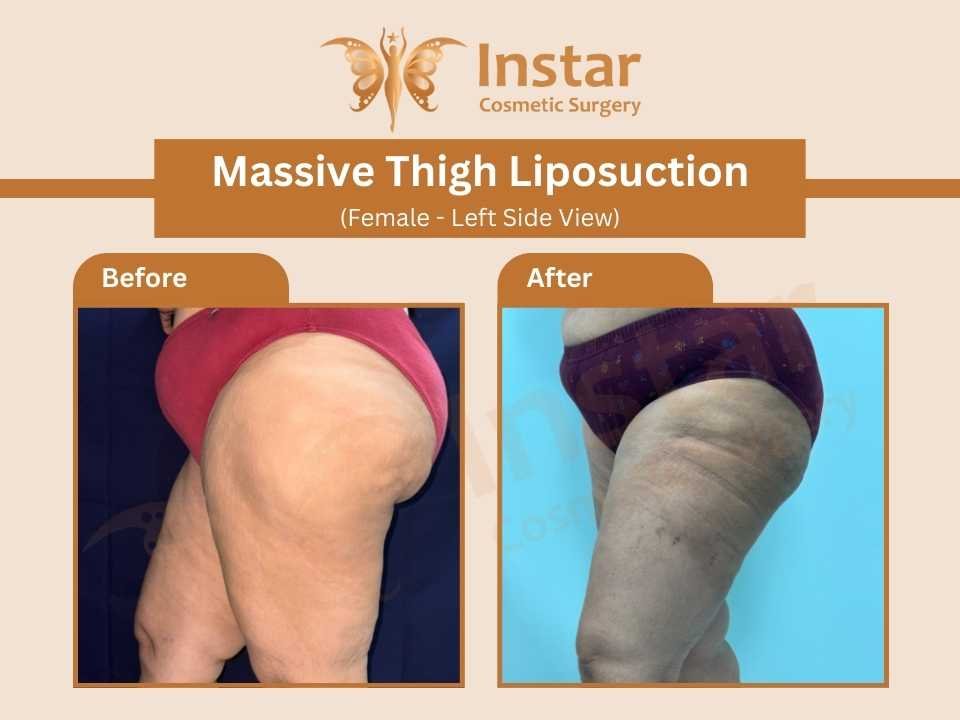 Massive-Thigh-Liposuction-female-leftside-view