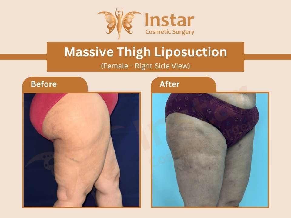 Massive-Thigh-Liposuction-female-rightside-view