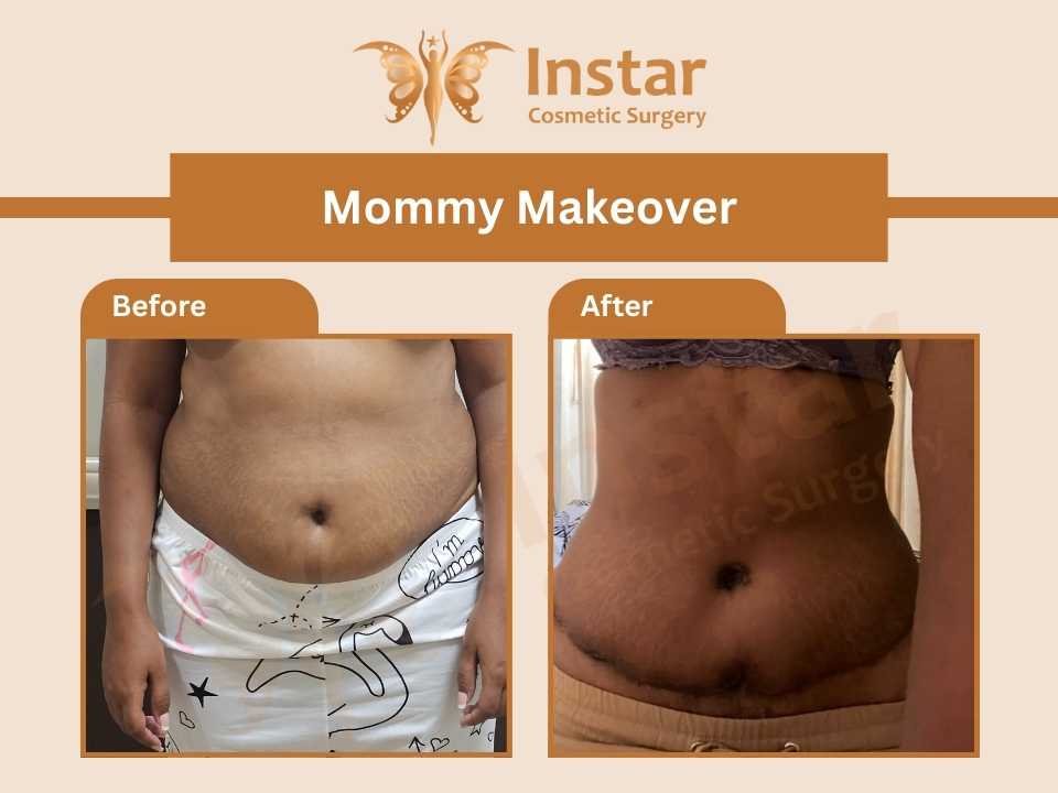 Mommy-Makeover-1