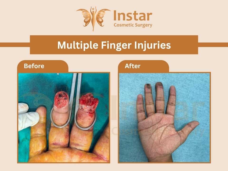 Multiple-Finger-Injuries