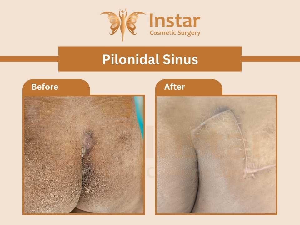 Pilonidal-Sinus-1