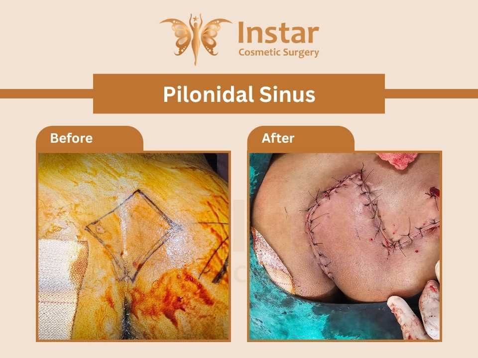 Pilonidal-Sinus-3