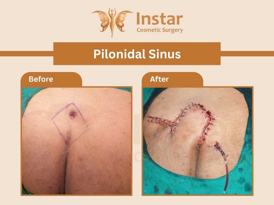 Pilonidal-Sinus-4