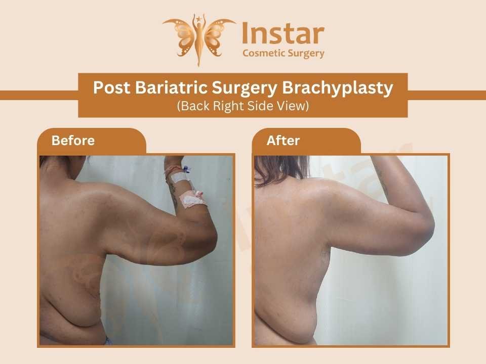 Post-Bariatric-Surgery-Brachyplasty-Back-Right-Side-View
