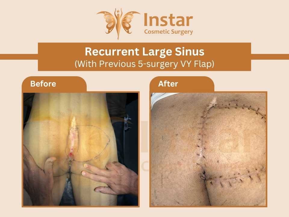 Recurrent-Large-sinus-with-previous-5-surgery-VY-Flap