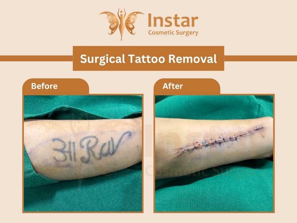 Surgical-Tattoo-Removal-2