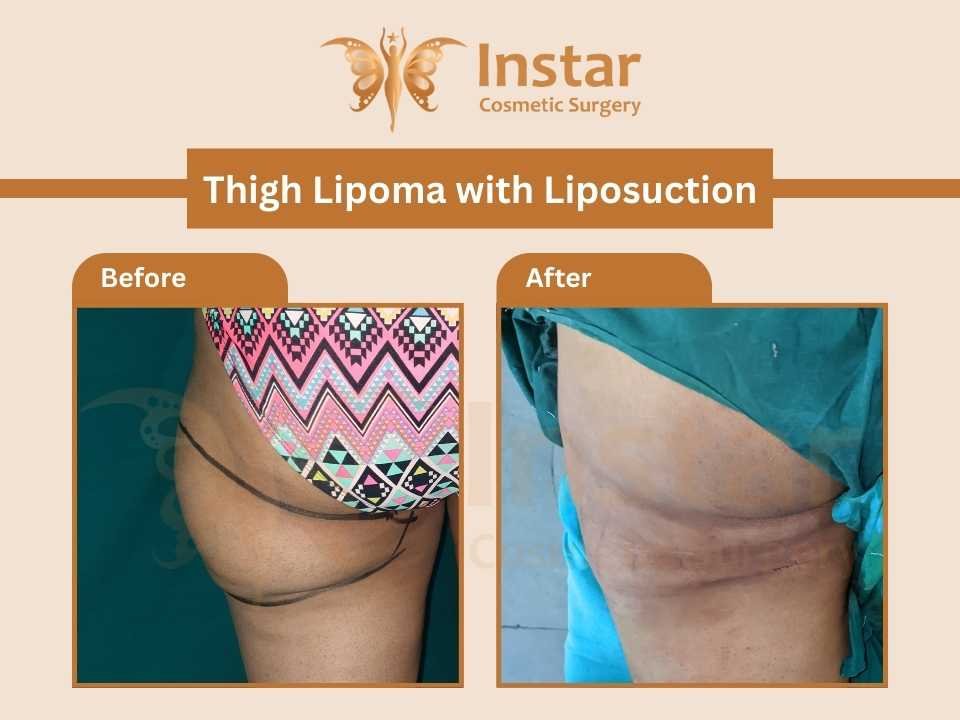 Thigh-Lipoma-with-Liposuction