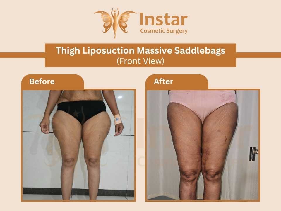 Thigh-Liposuction-Massive-Saddlebags-Front-View