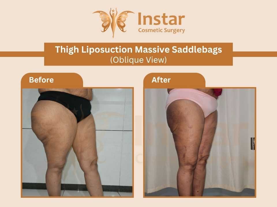 Thigh-Liposuction-Massive-Saddlebags-Oblique-View