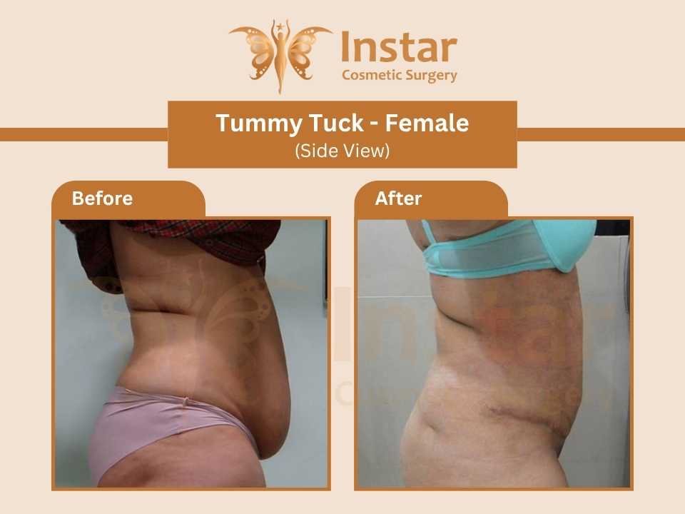Tummy-Tuck-Female-Side-View