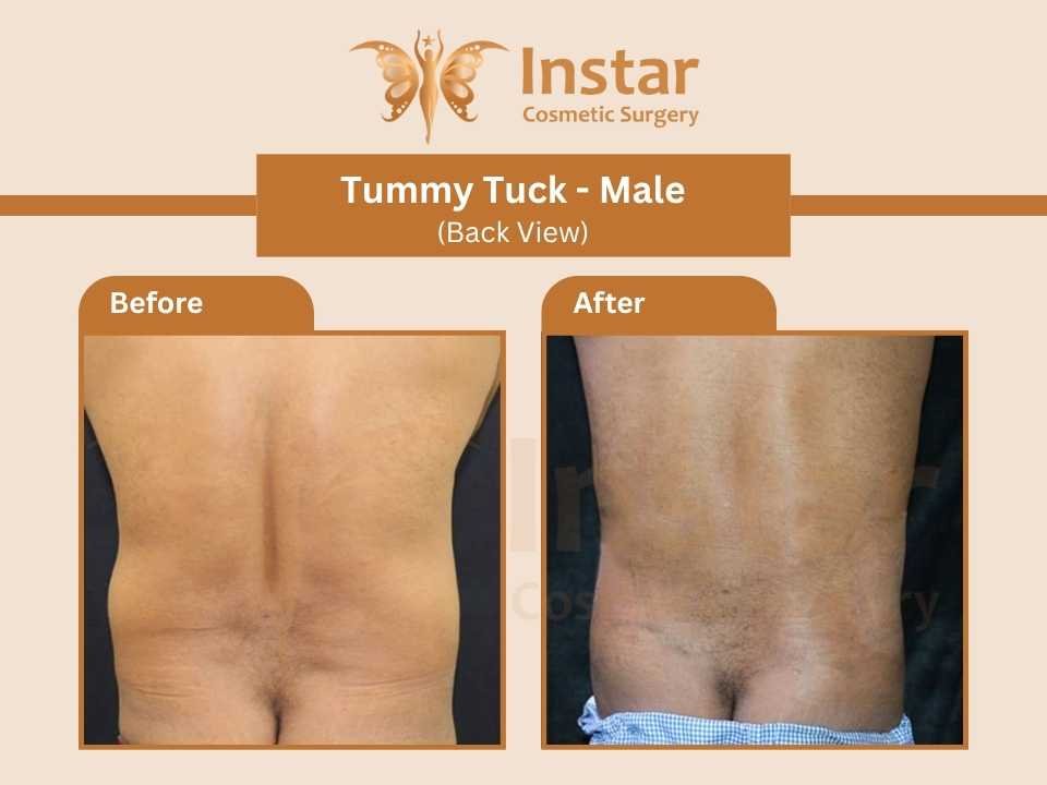 Tummy-Tuck-Male-Back-View