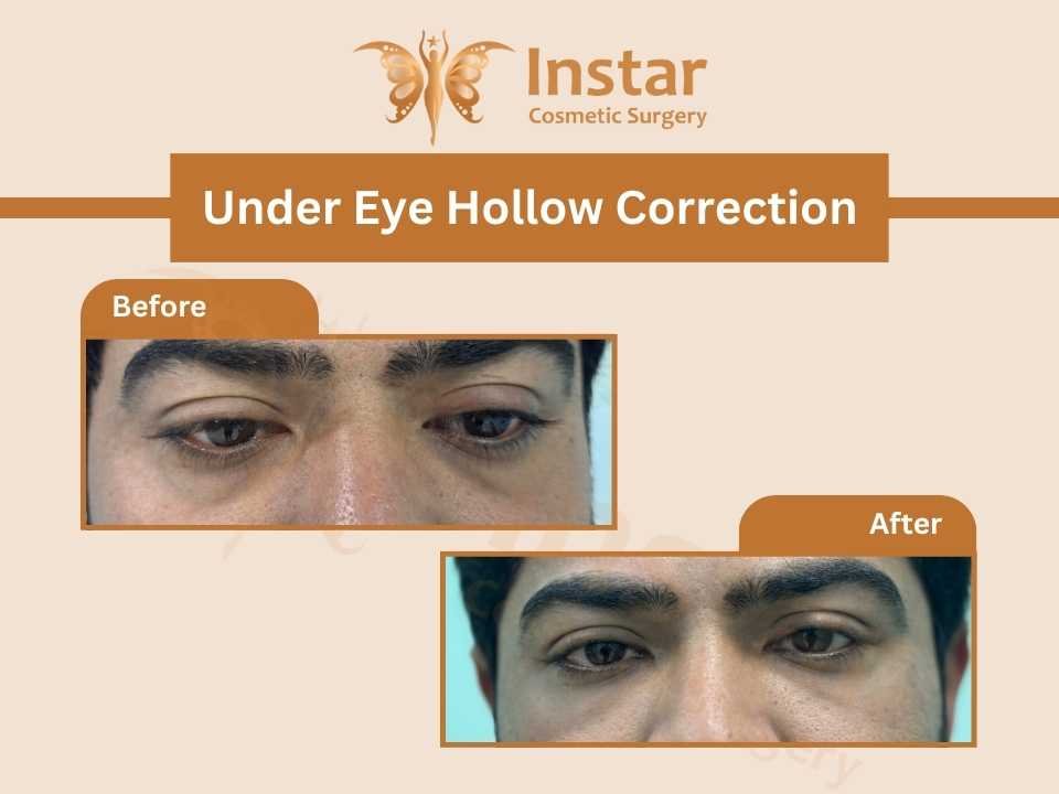 Under-Eye-Hollow-Correction