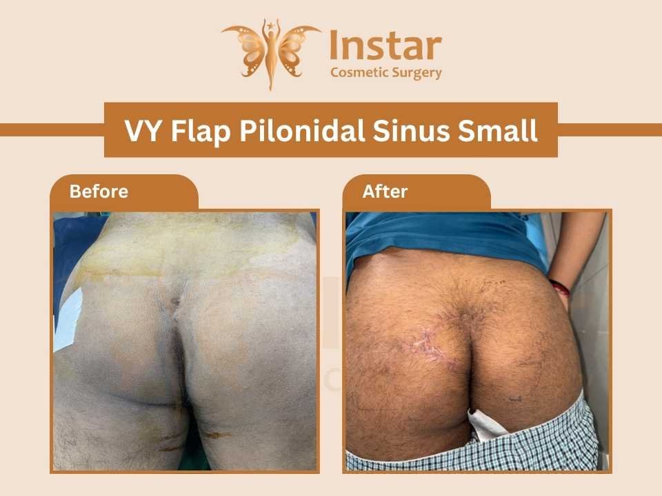 VY-Flap-Pilonidal-Sinus-Small