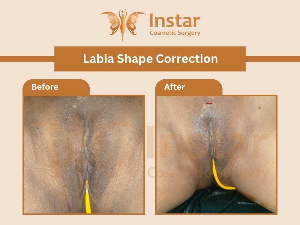 labia-shape-correction